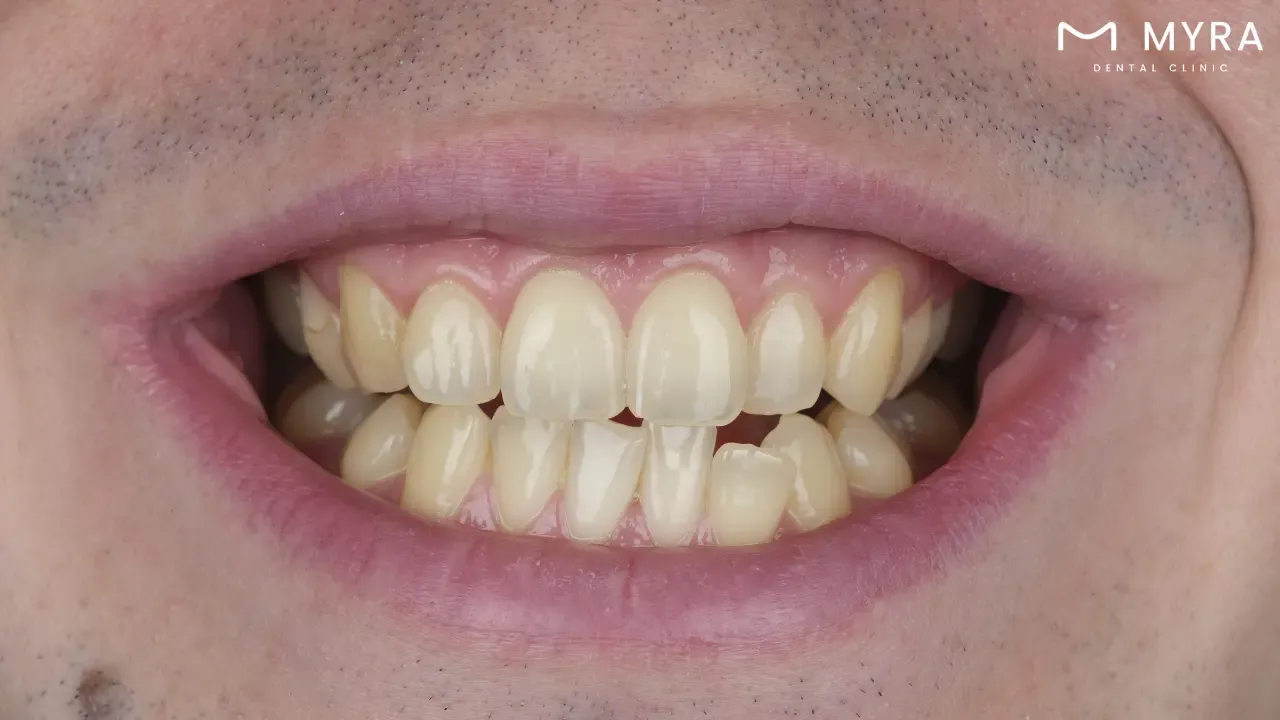 What are the symptoms of crooked teeth?