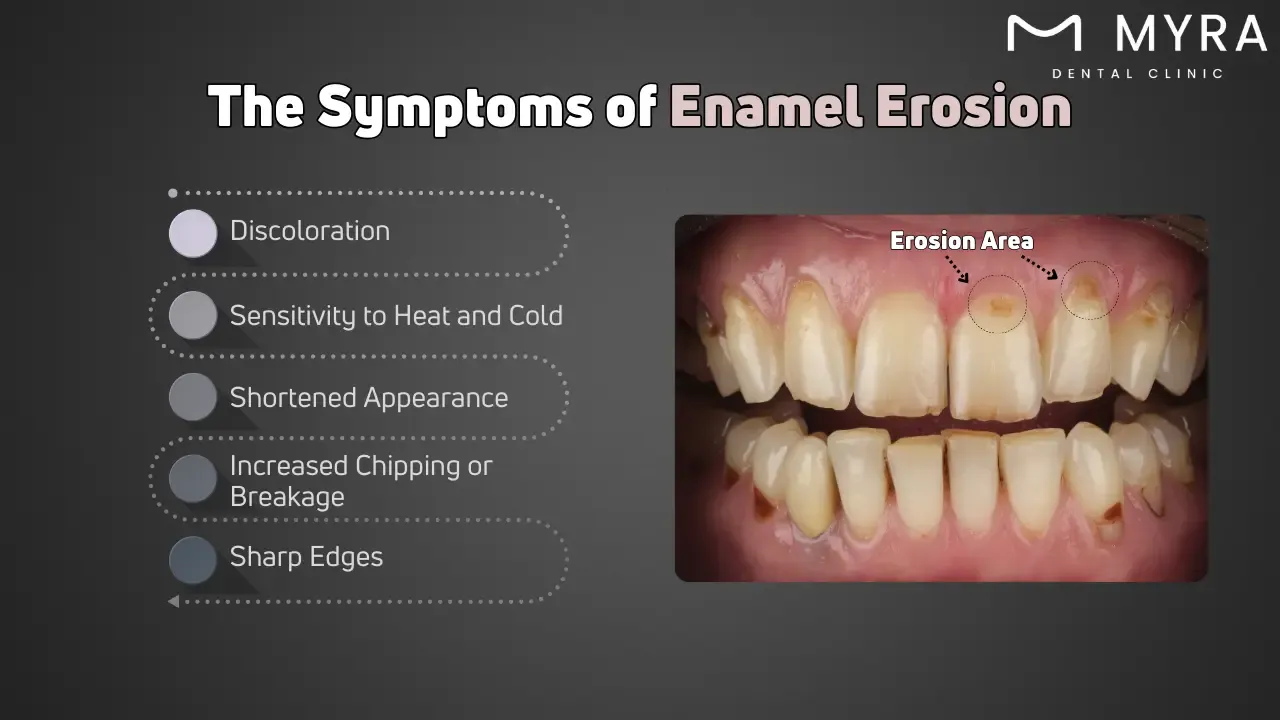 What are the symptoms of enamel erosion?