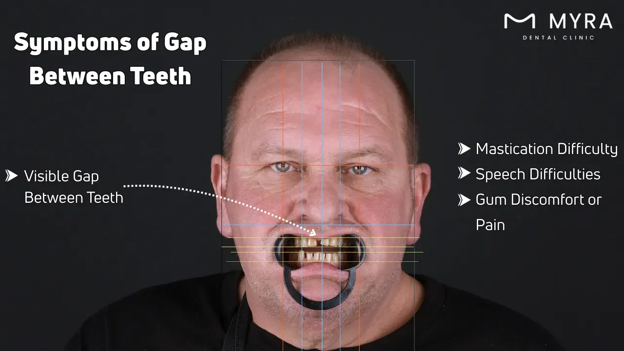 What are the symptoms of a gap between teeth?