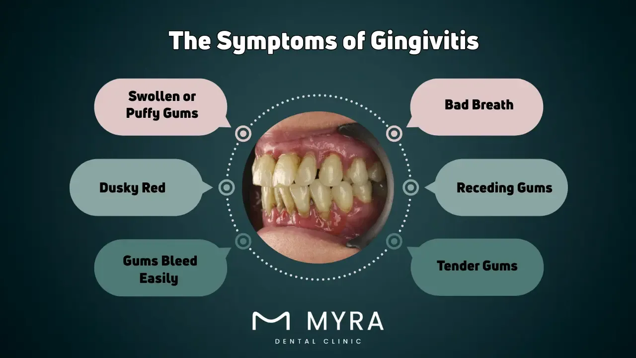 What are the symptoms of gingivitis?