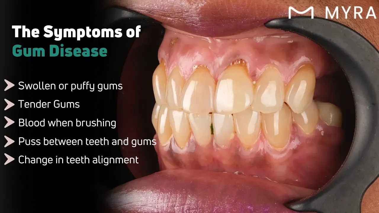 What are the symptoms of gum disease?