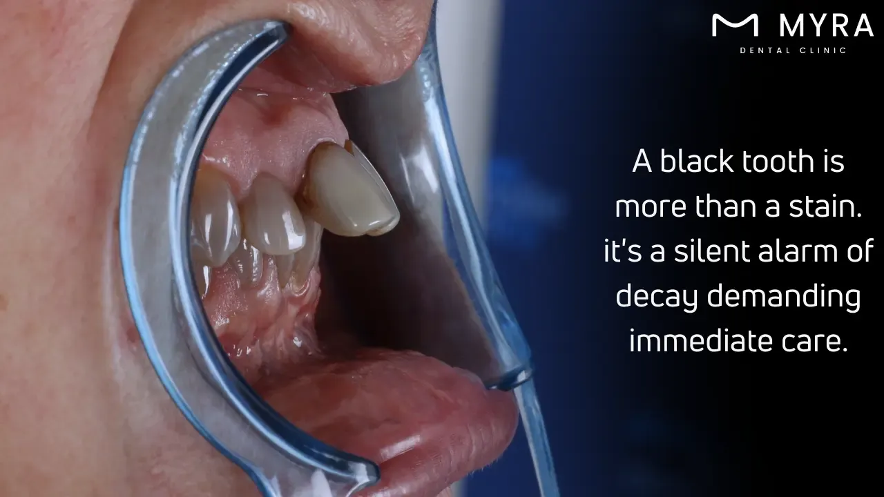 What are the symptoms of having a black tooth?