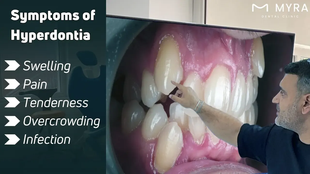 What are the symptoms of hyperdontia?