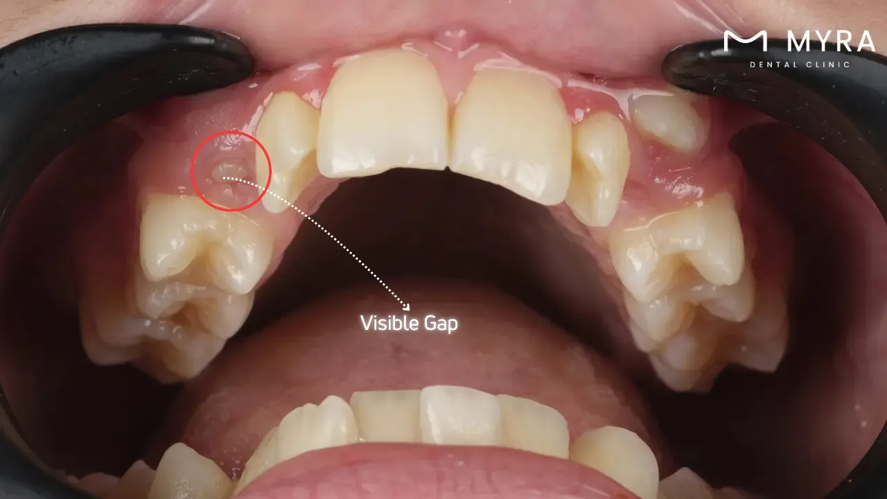 What are the symptoms of impacted teeth?