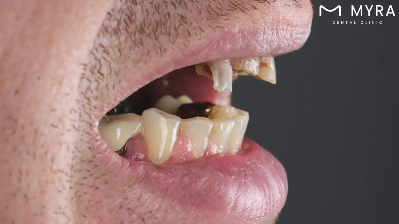 What are the symptoms of tooth decay?