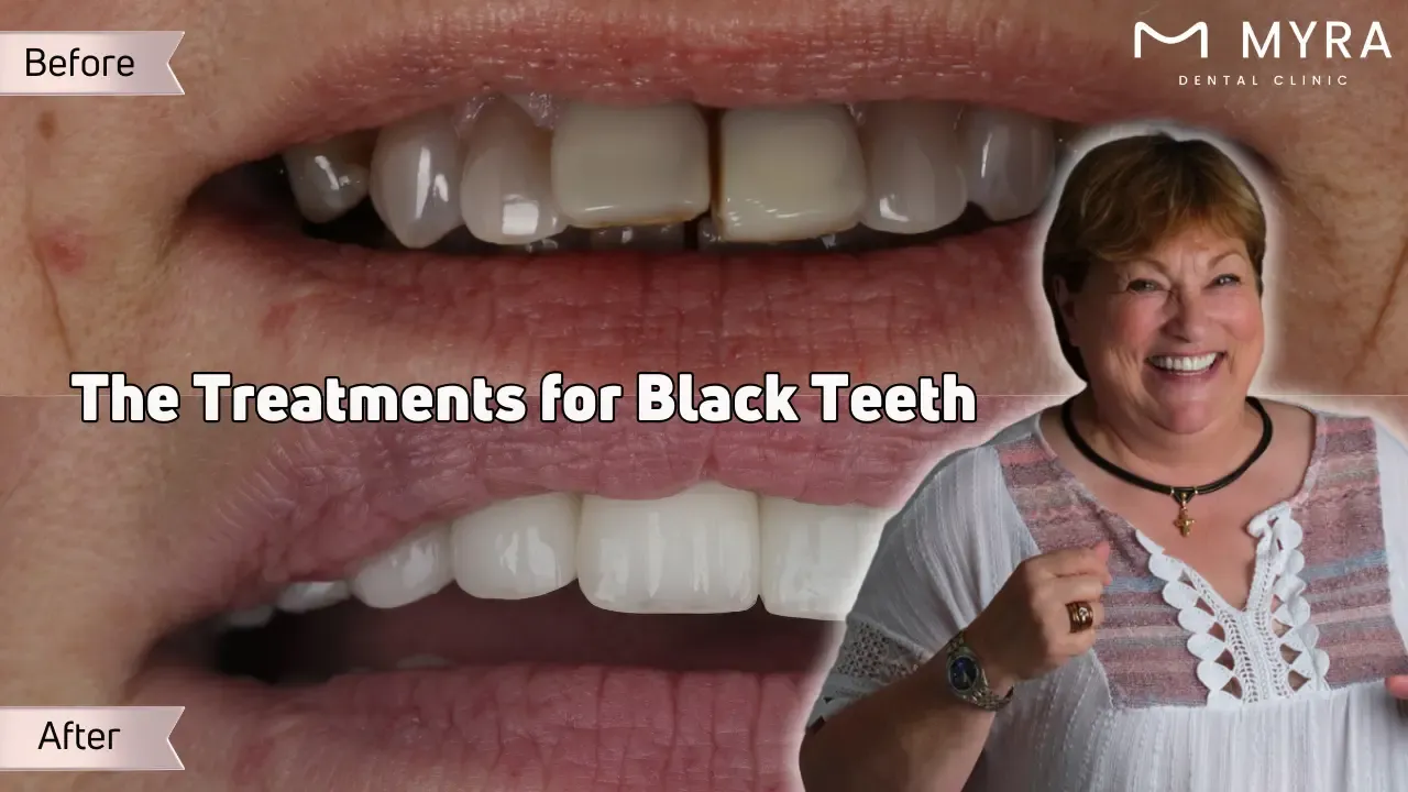 What are the treatments for black teeth?