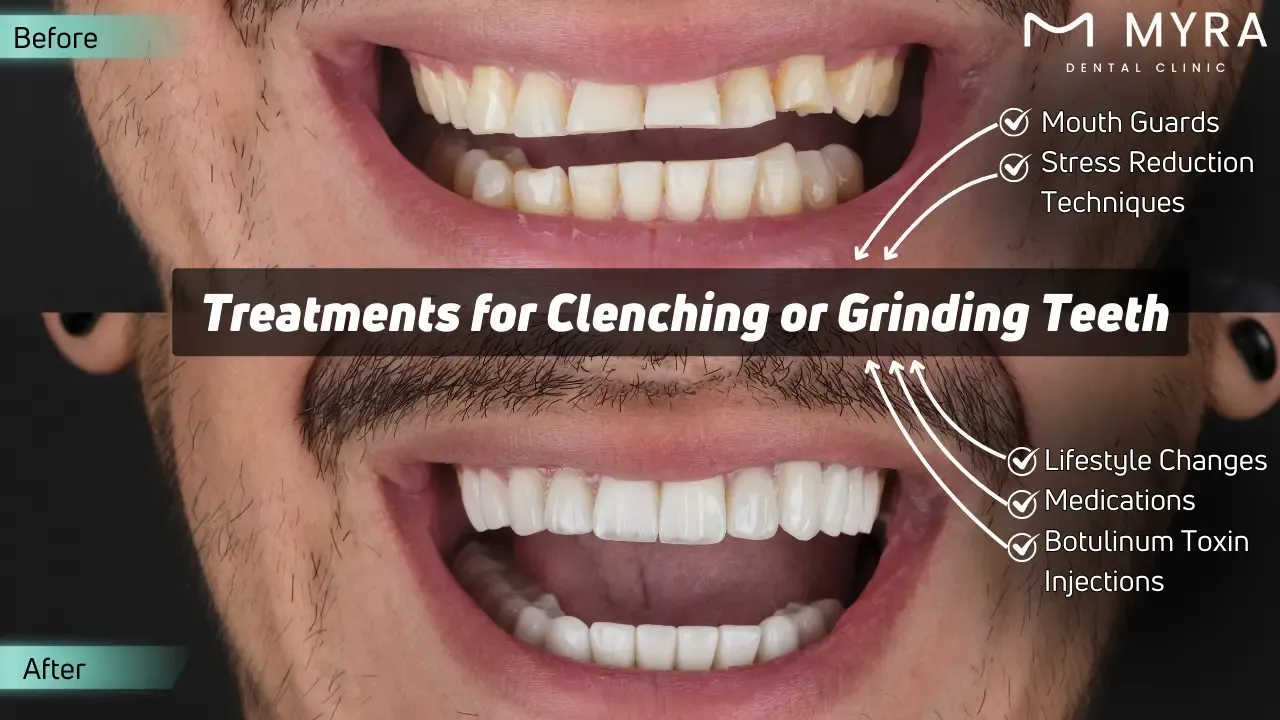 What are the treatments for clenching or grinding your teeth?