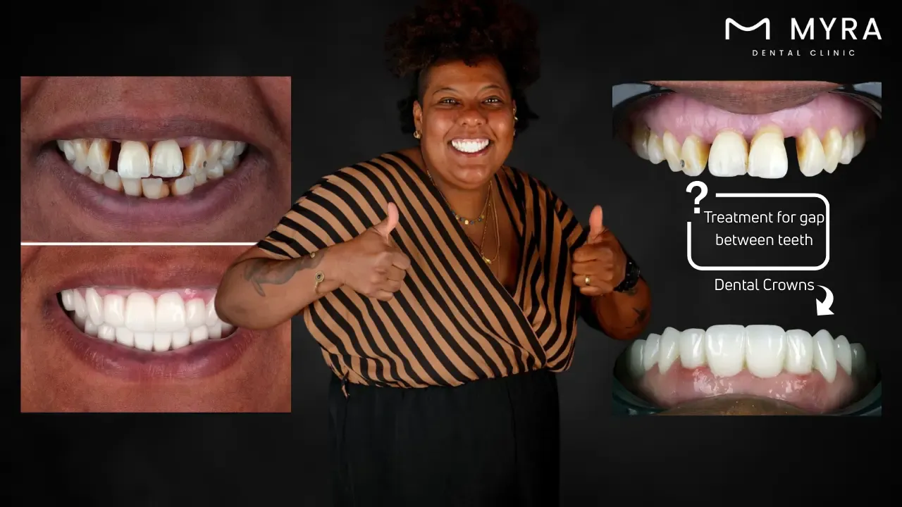 What are the treatments for a gap between teeth?