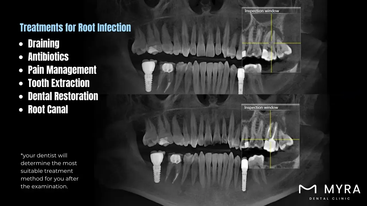 What are the treatments for a root infection in turkey?