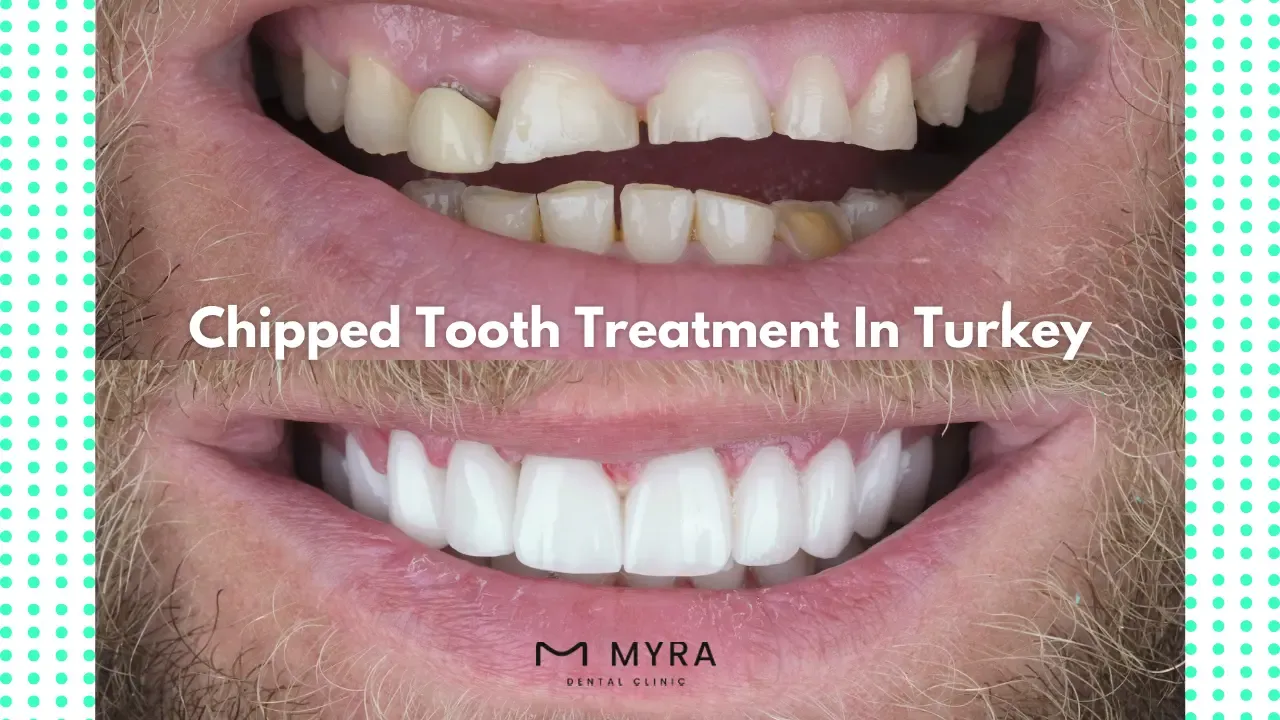 What are the treatments for a chipped tooth?
