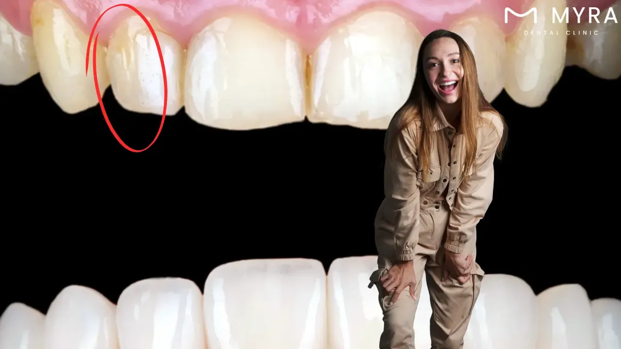 What are the treatments for a cracked tooth?