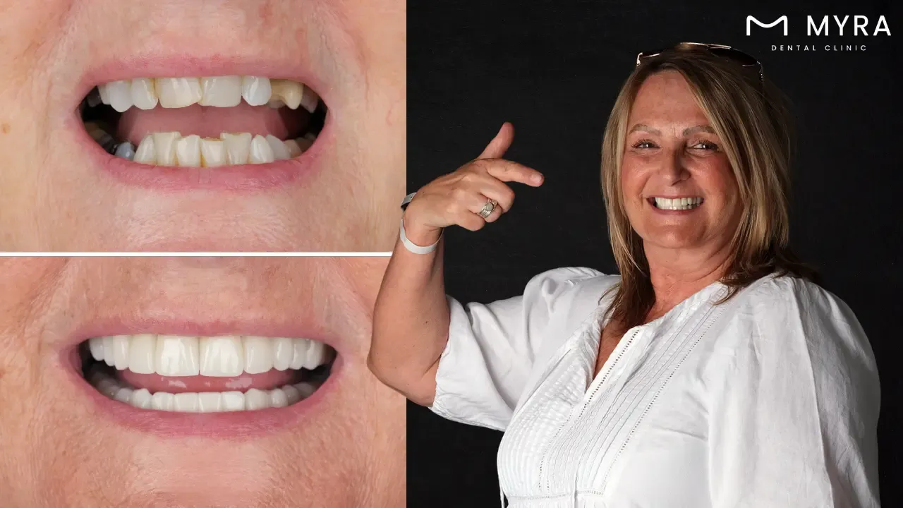 What are the treatments for crooked teeth?