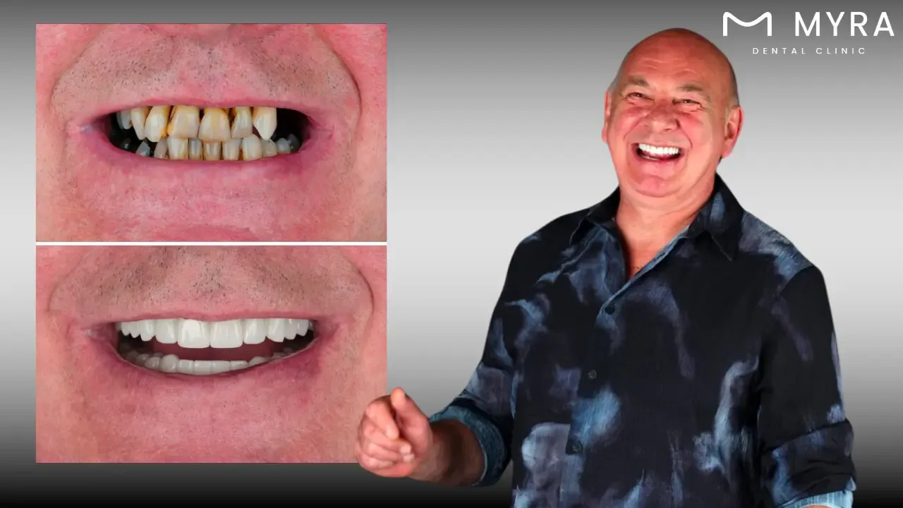 What are the treatments for tooth decay?