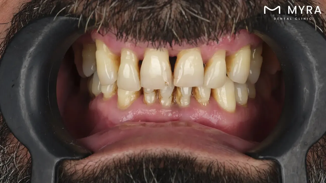 What are the types of cavities?