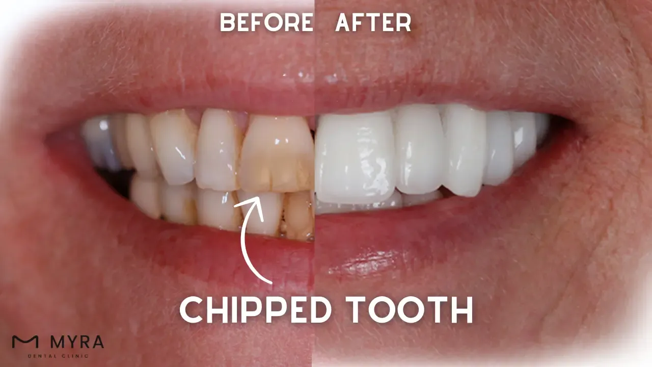 What are the types of chipped teeth?
