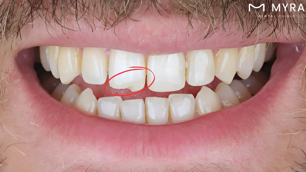 What are the types of cracked teeth?