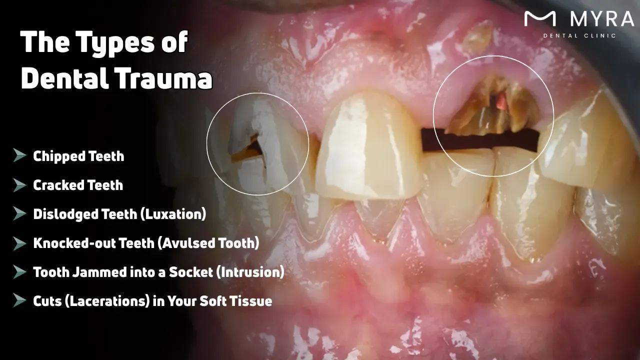 What are the types of dental trauma?