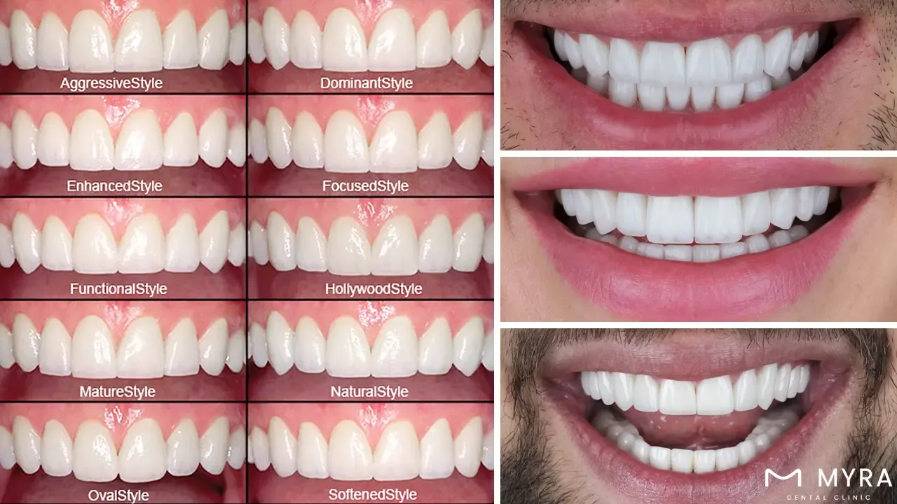 What are the types of dental veneers
