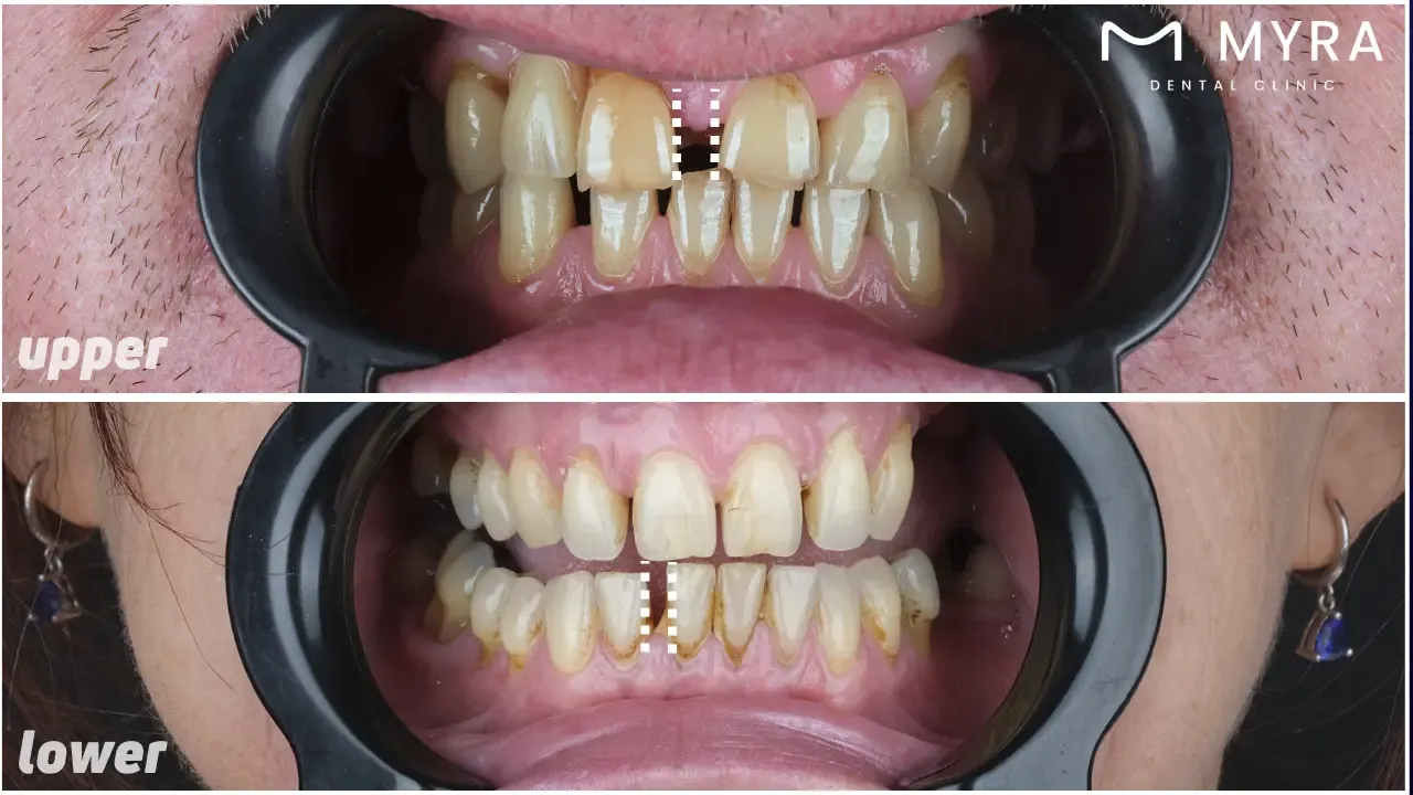 What are the types of diastema?