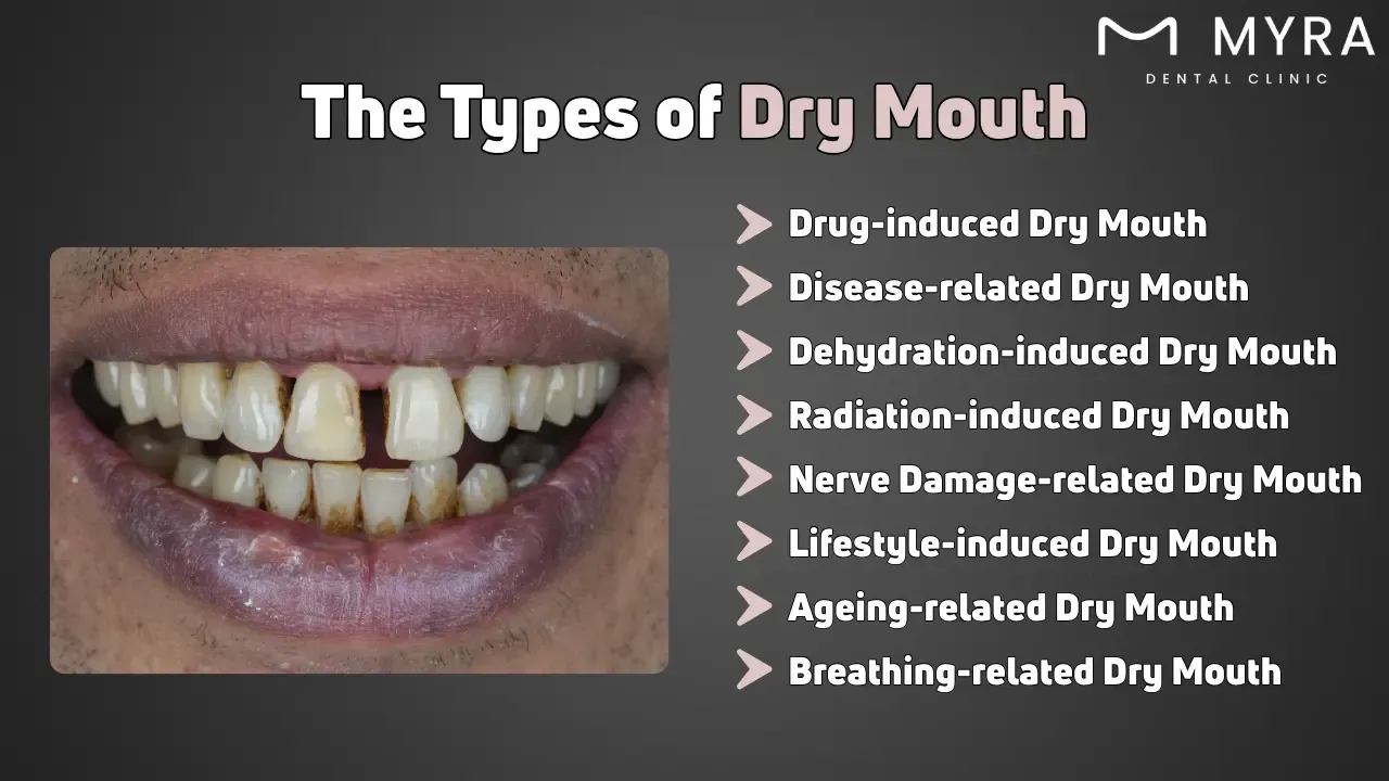 What are the types of dry mouth?