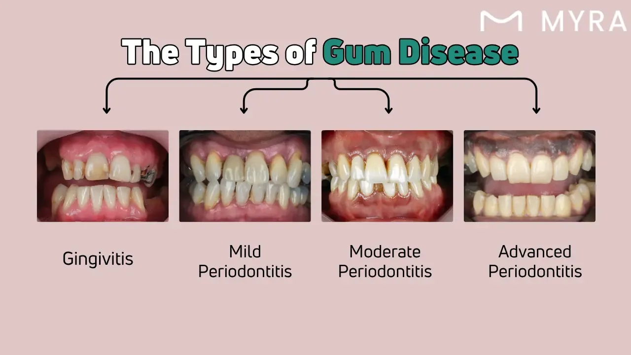 What are the types of gum disease?
