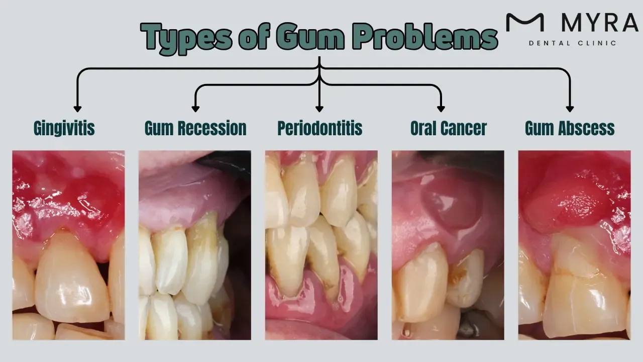What are the types of gum problems?