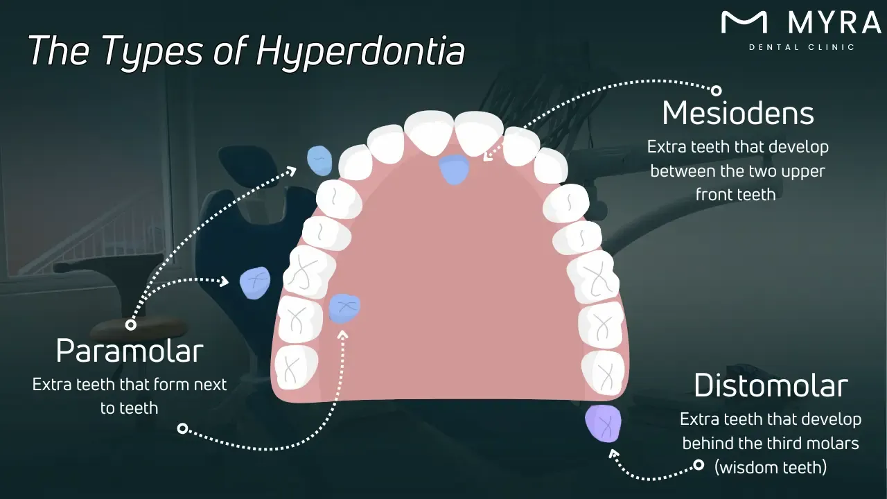 What are the types of hyperdontia?
