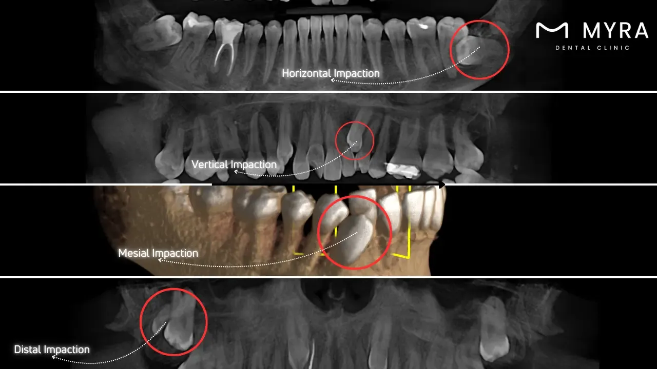 What are the types of impacted teeth?