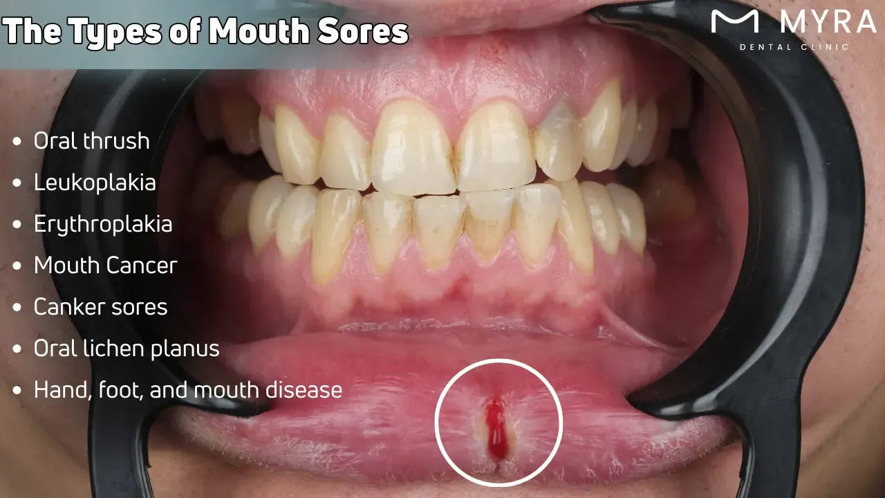 What are the types of mouth sores?