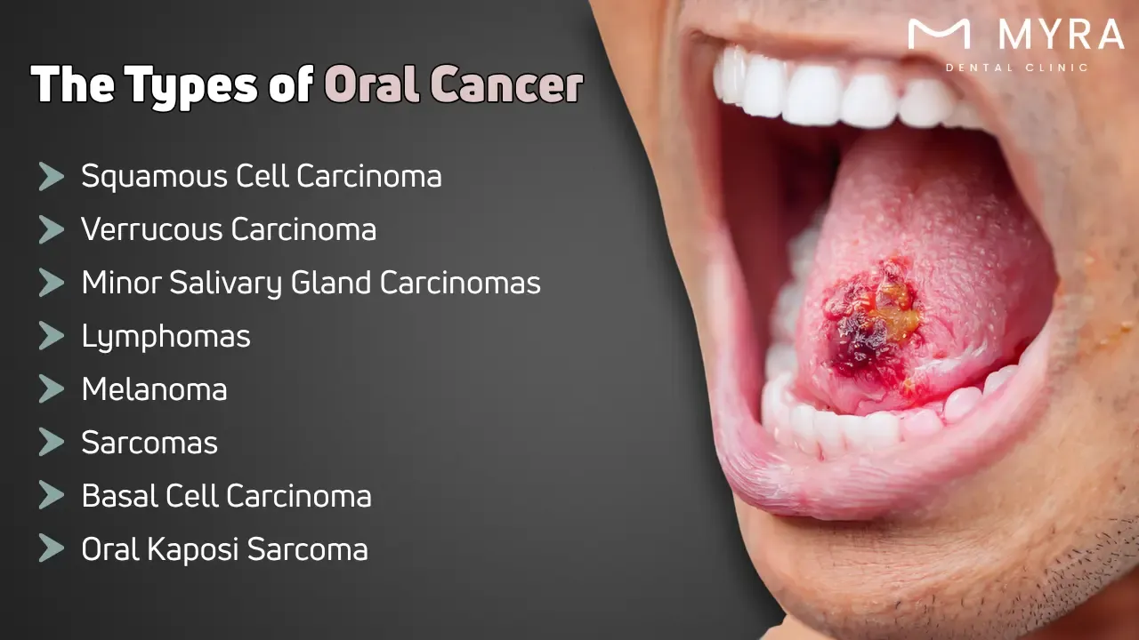 What are the types of oral cancer?