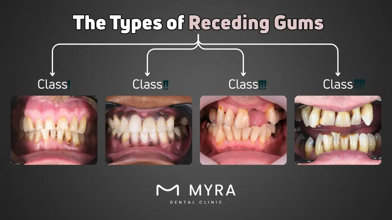 What are the types of receding gums?