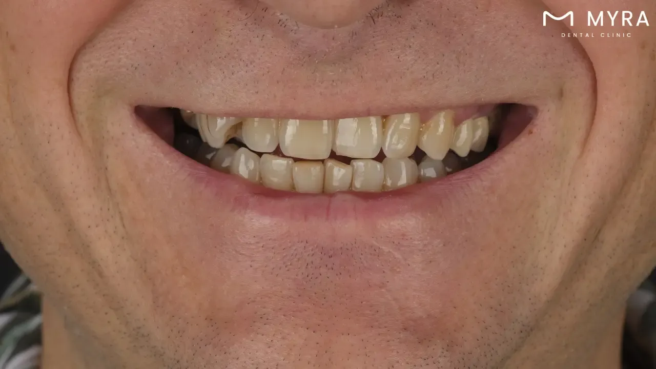 What are the types of stained teeth?
