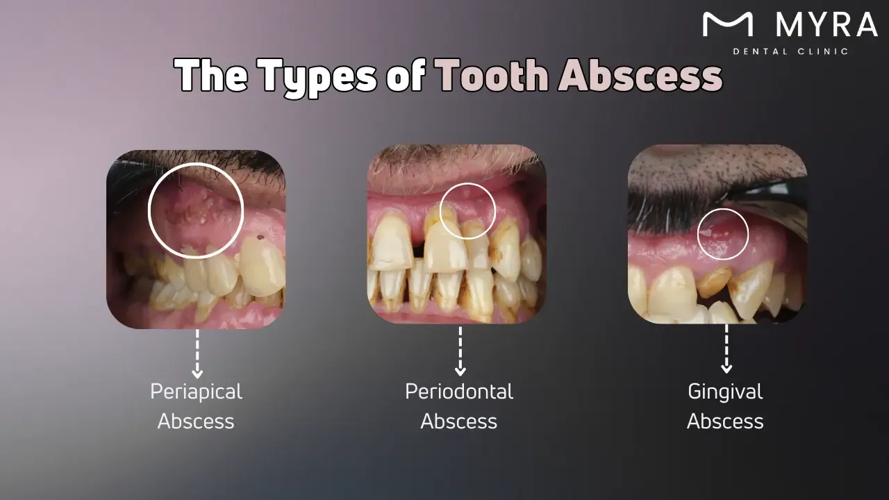 What are the types of tooth abscess?