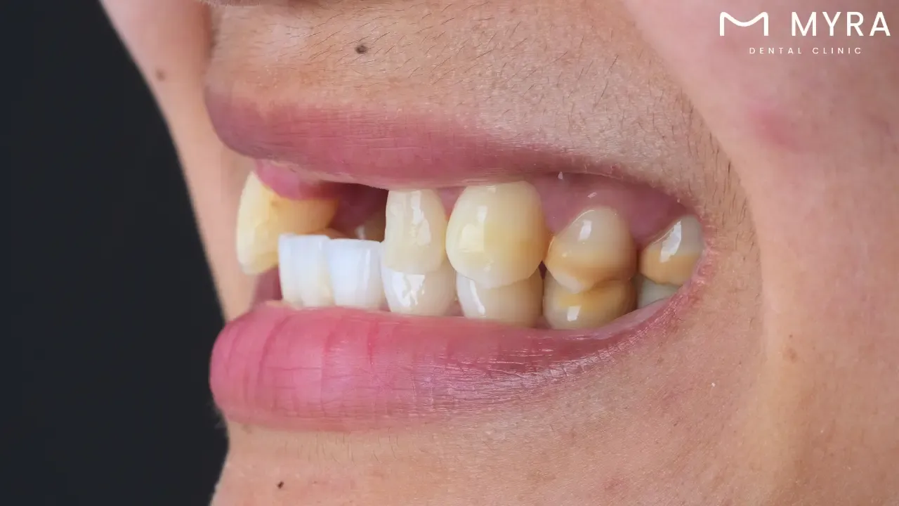 What are the types of tooth decay?
