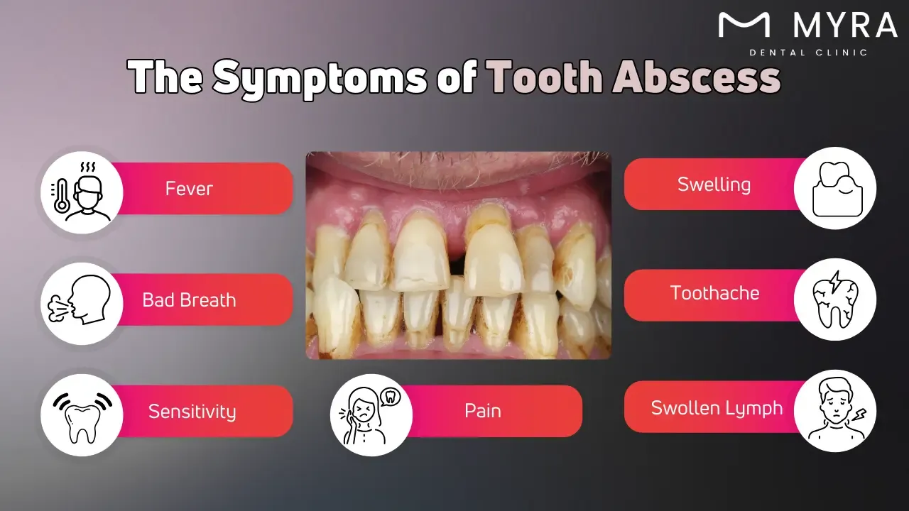 What are tooth abscess symptoms?