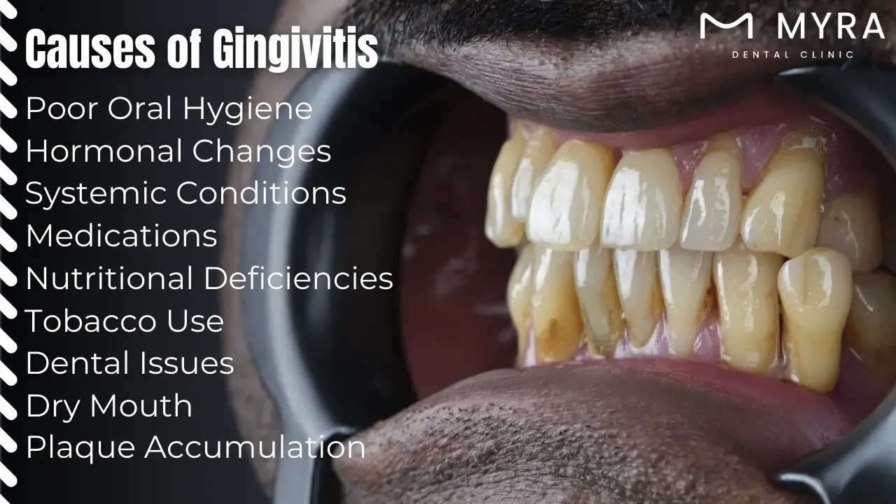 What causes gingivitis in turkey?