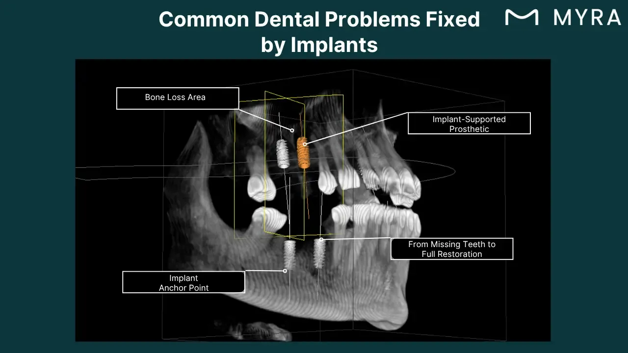 what-common-dental-problems-can-be-fixed-by-dental-implant.webp