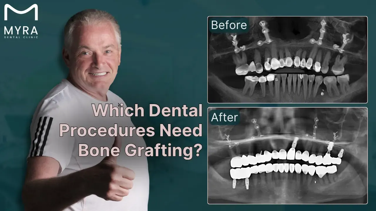 what dental treatments require bone grafting?