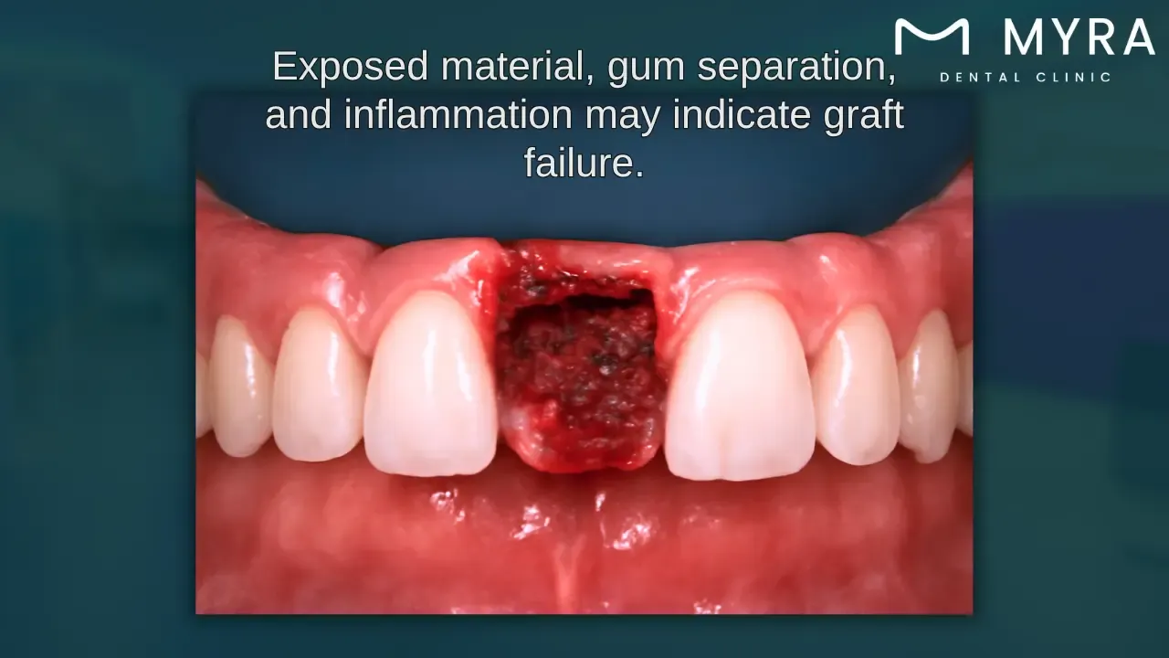 what does a failed bone graft look like?