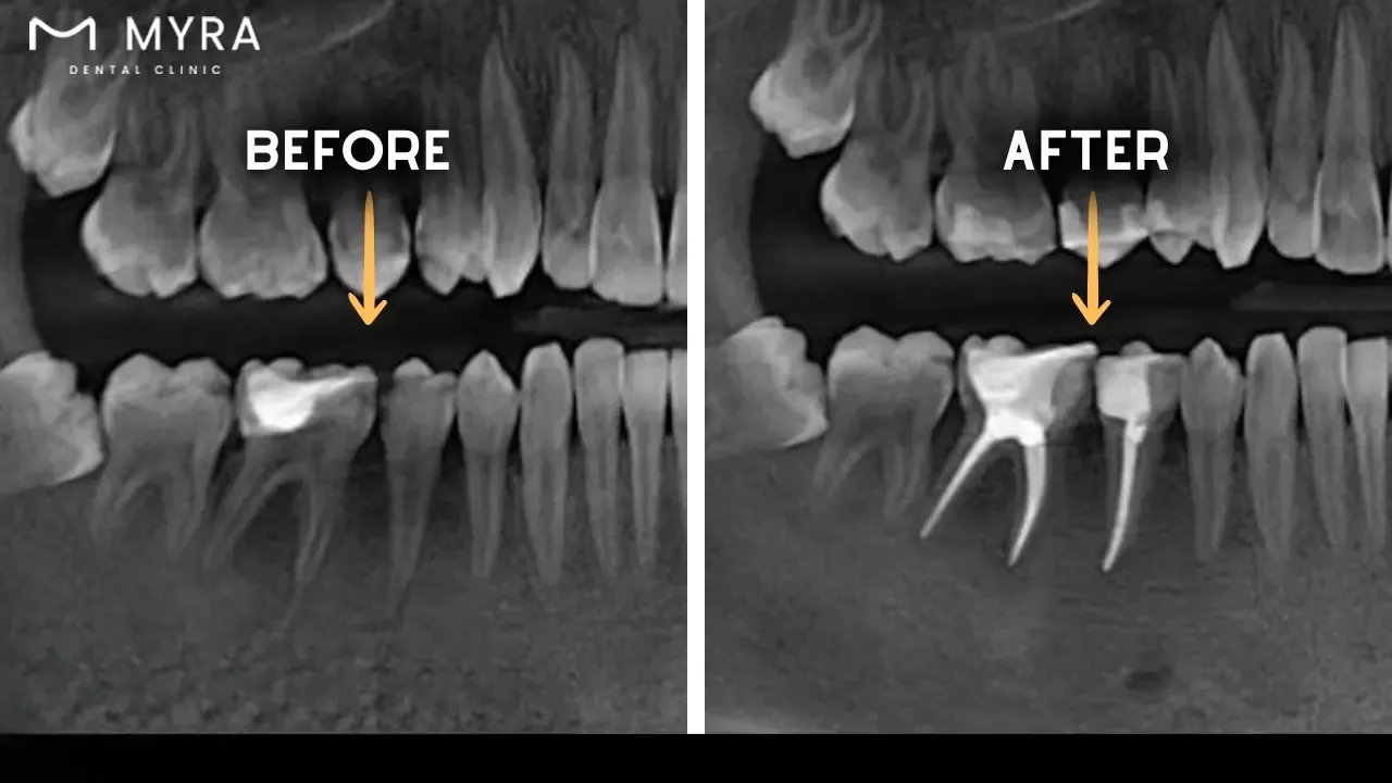 what does an endodontist do?