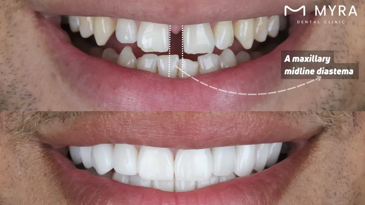 What does diastema look like?