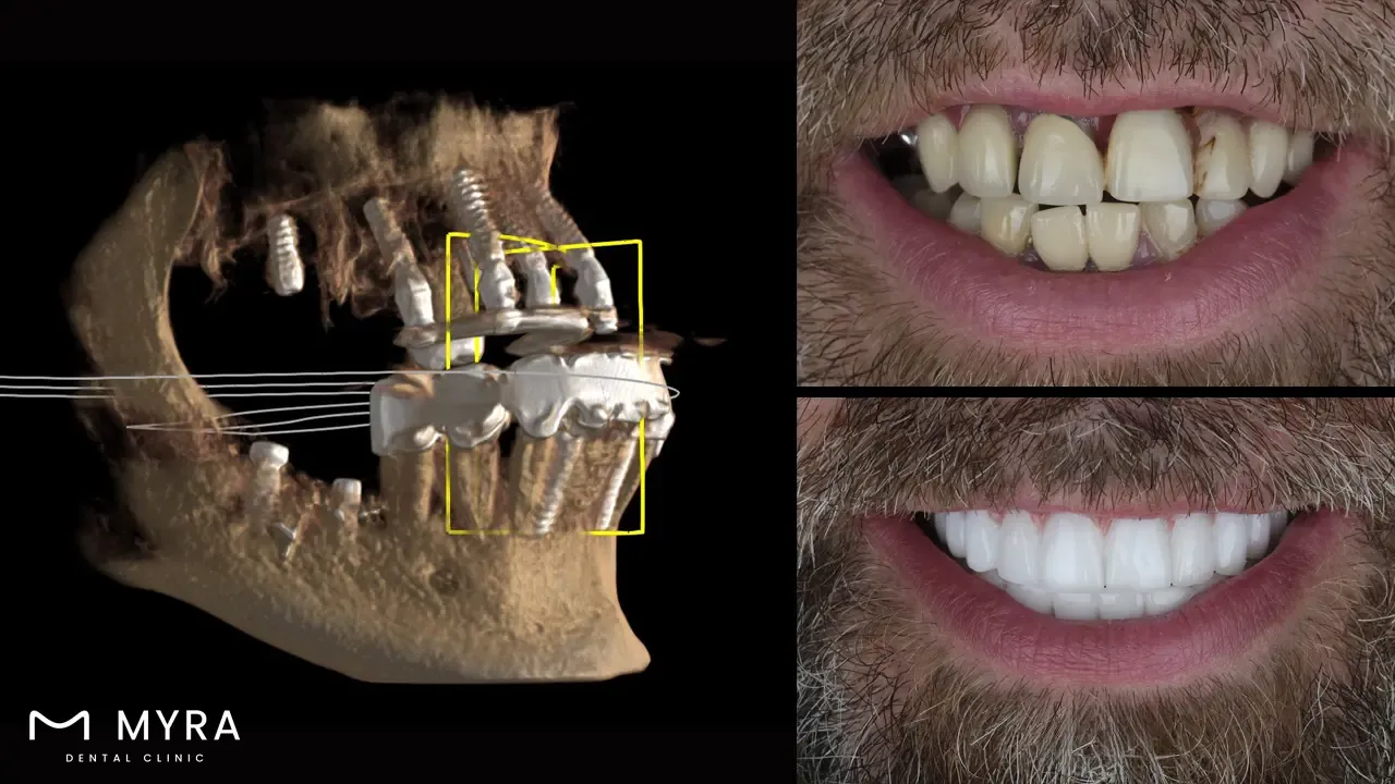 what-factors-determine-the-quantity-needed-for-an-upper-denture-implant.webp