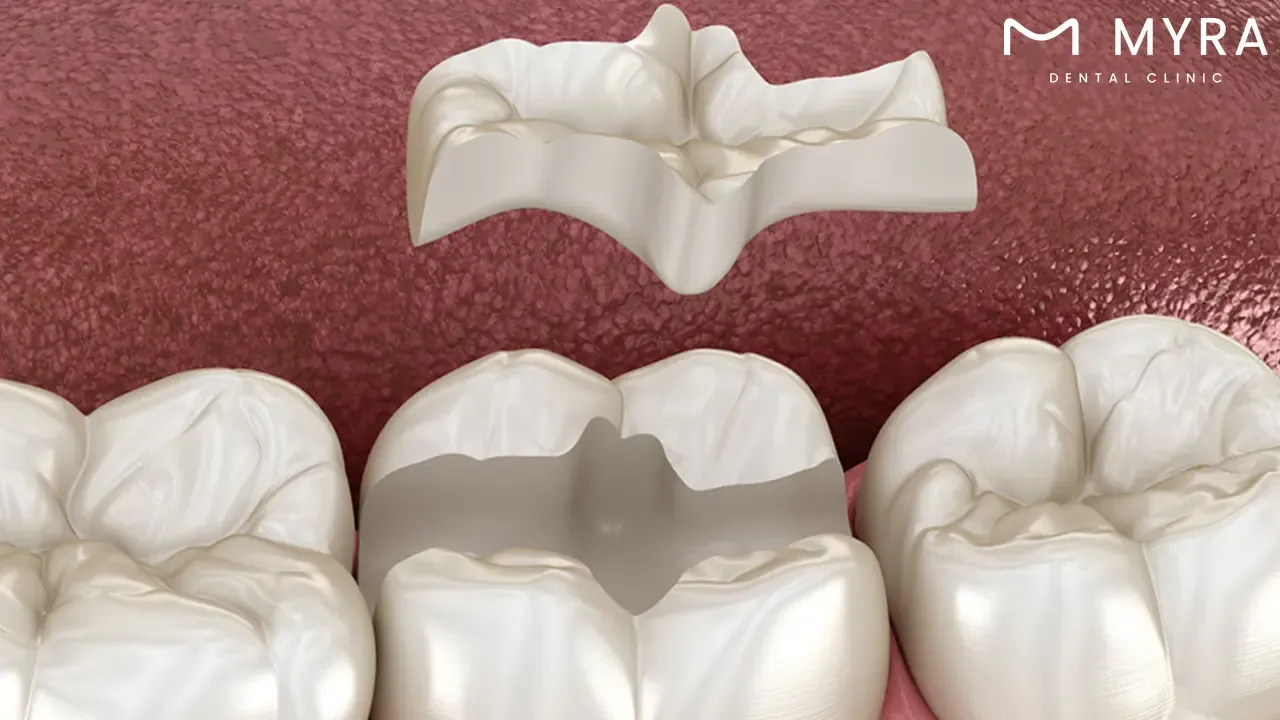 what factors determine whether a tooth is suitable for an inlay restoration?
