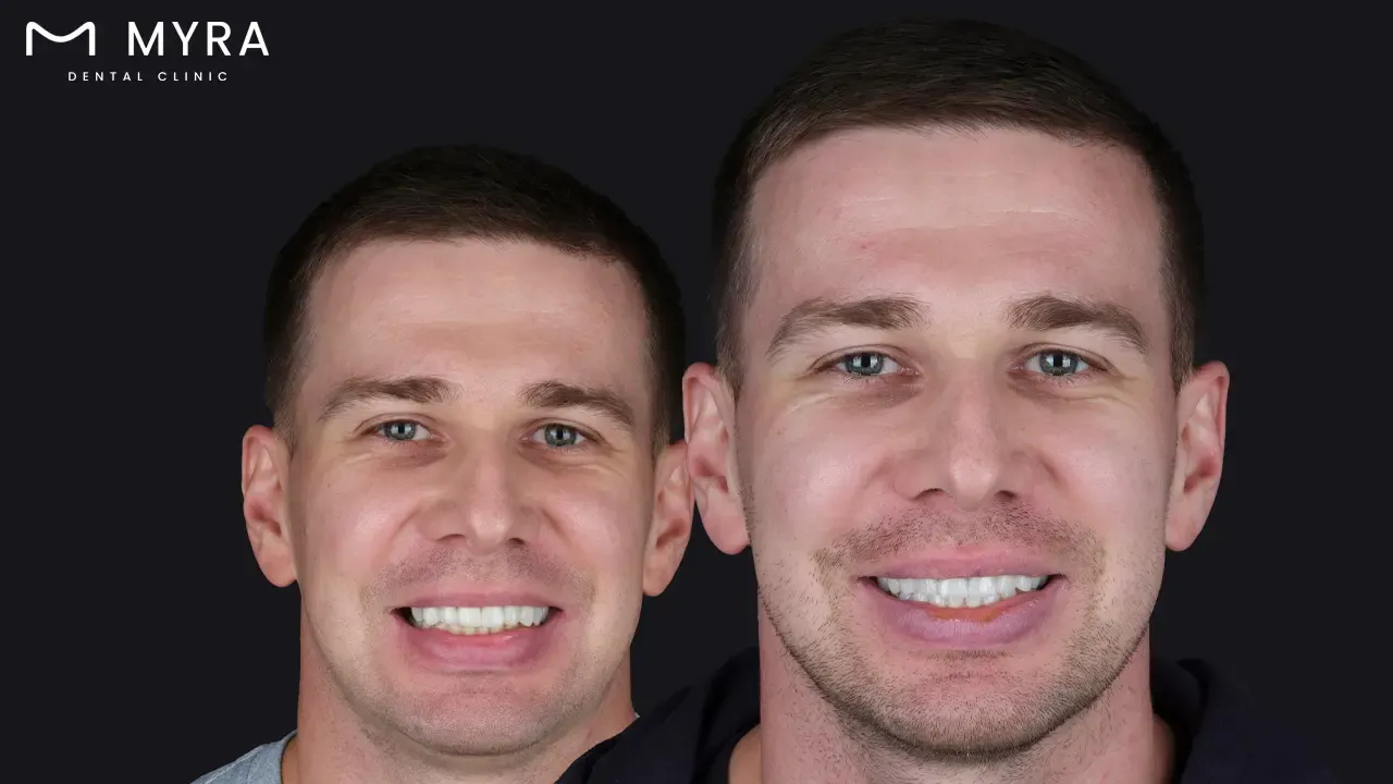 What is a dental crown?