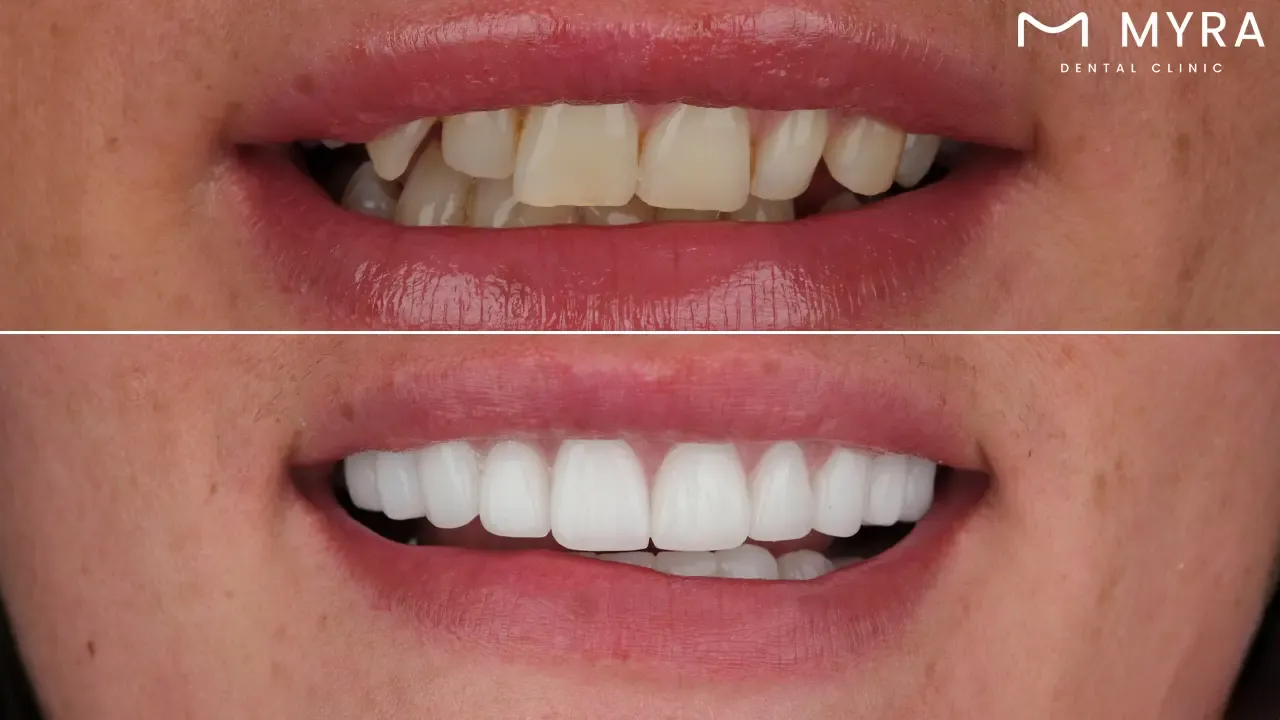 What is a narrow smile?