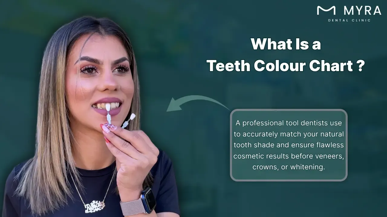 what is a teeth colour chart?