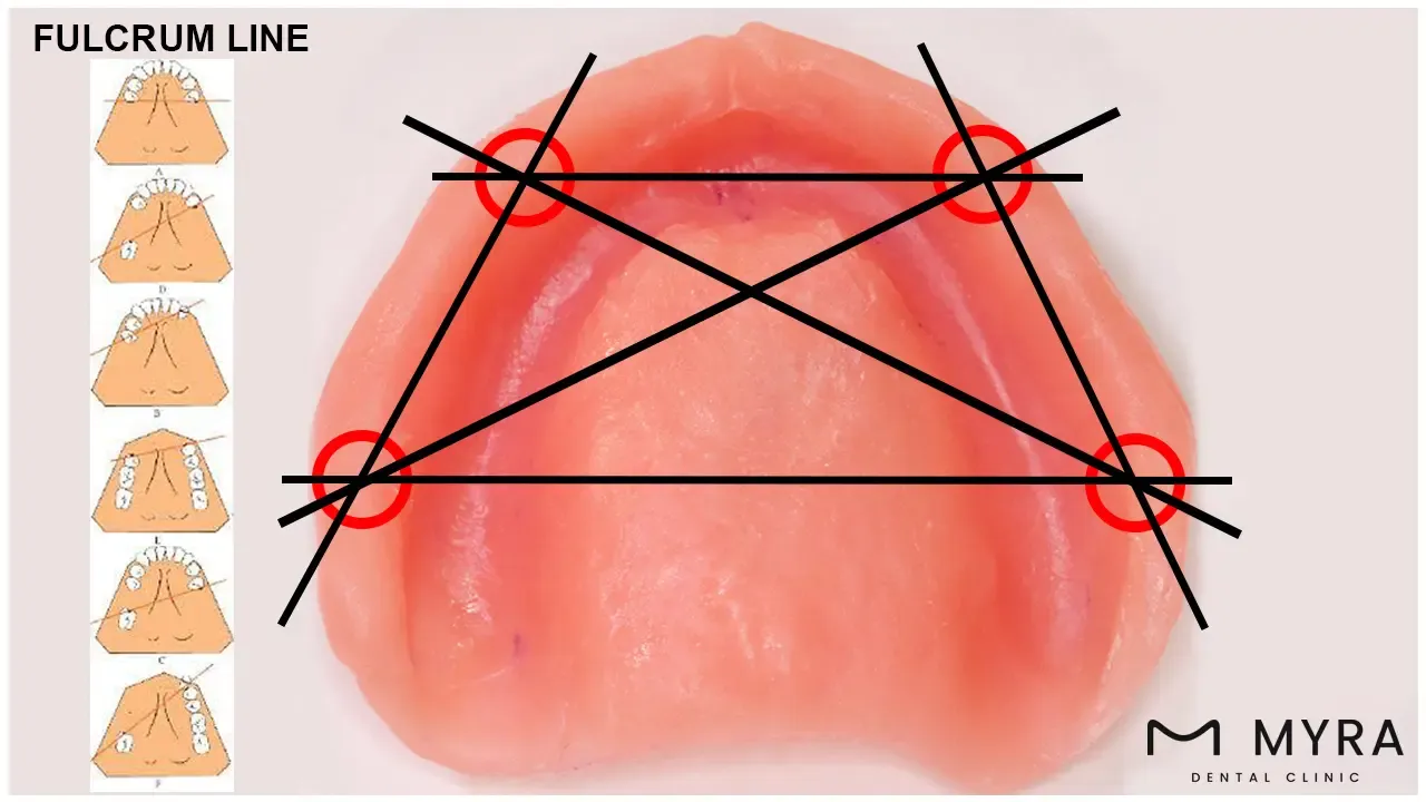 what is an all-on-4 dental implant?