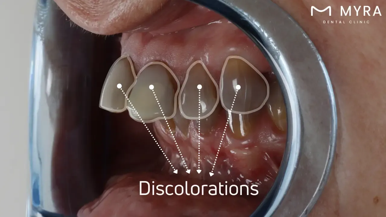 What is black teeth?