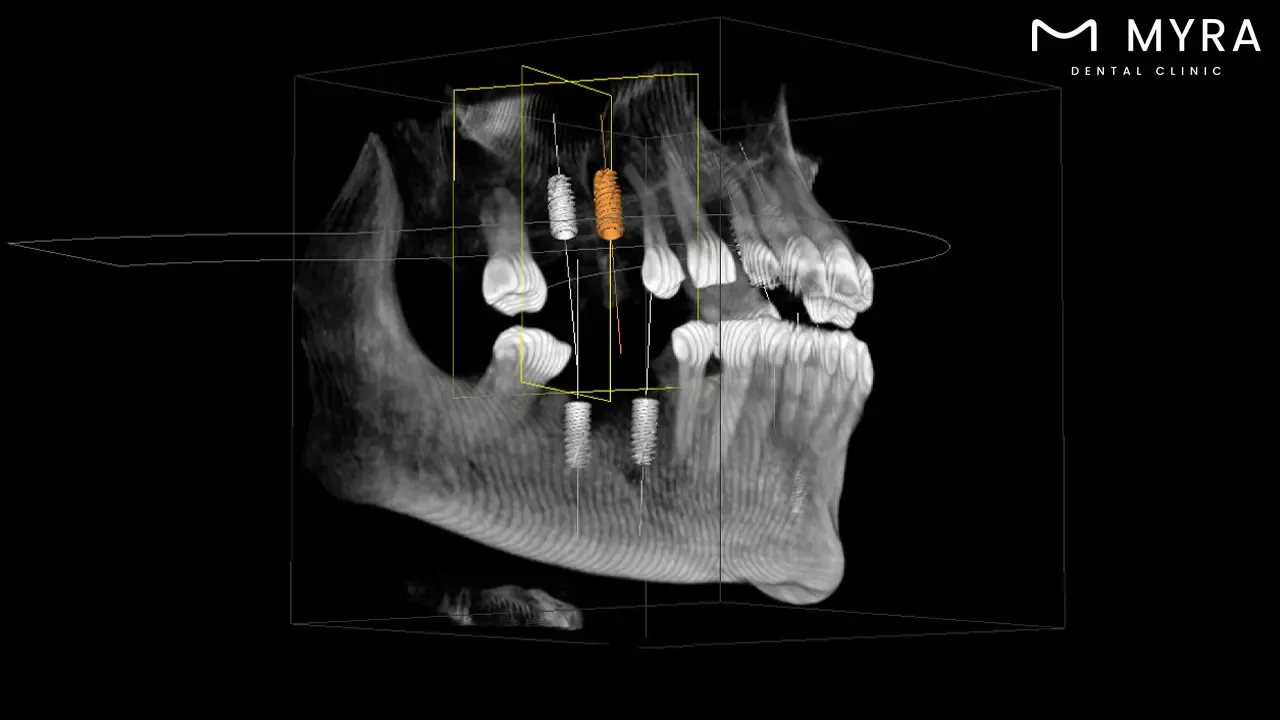 what-is-dental-implant.webp