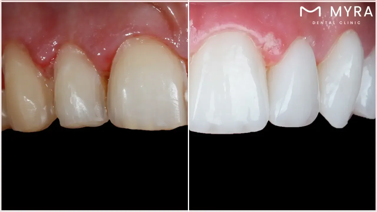 What is a dental laminate?